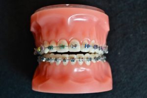 Bagues en métal au Cabinet d'Orthodontie de CAVAILLON des drs. CHARLOIS Thierry, RAMPAL François, BOURLA Joëlle, QUILICHINI Thomas