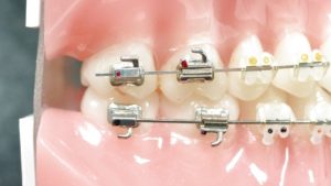 Urgence - fil qui dépasse - au Cabinet d'Orthodontie de CAVAILLON des drs. CHARLOIS Thierry, RAMPAL François, BOURLA Joëlle, QUILICHINI Thomas