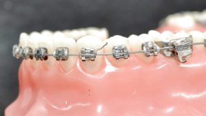 Urgence - ligature qui dépasse - au Cabinet d'Orthodontie de CAVAILLON des drs. CHARLOIS Thierry, RAMPAL François, BOURLA Joëlle, QUILICHINI Thomas